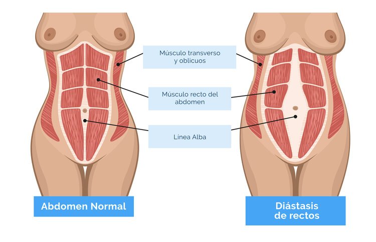 diastasis-abdominal-andres-perez-grassano