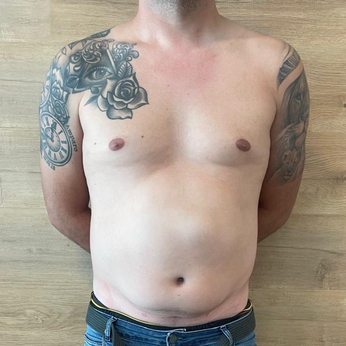 Fotos-Antes-Cirugia-diastasis-convencional (1)