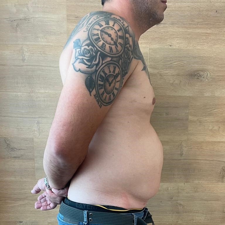 Fotos-Antes-Cirugia-diastasis-convencional (2-)