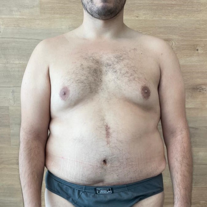 Fotos-Antes-Cirugia-diastasis-convencional (3)