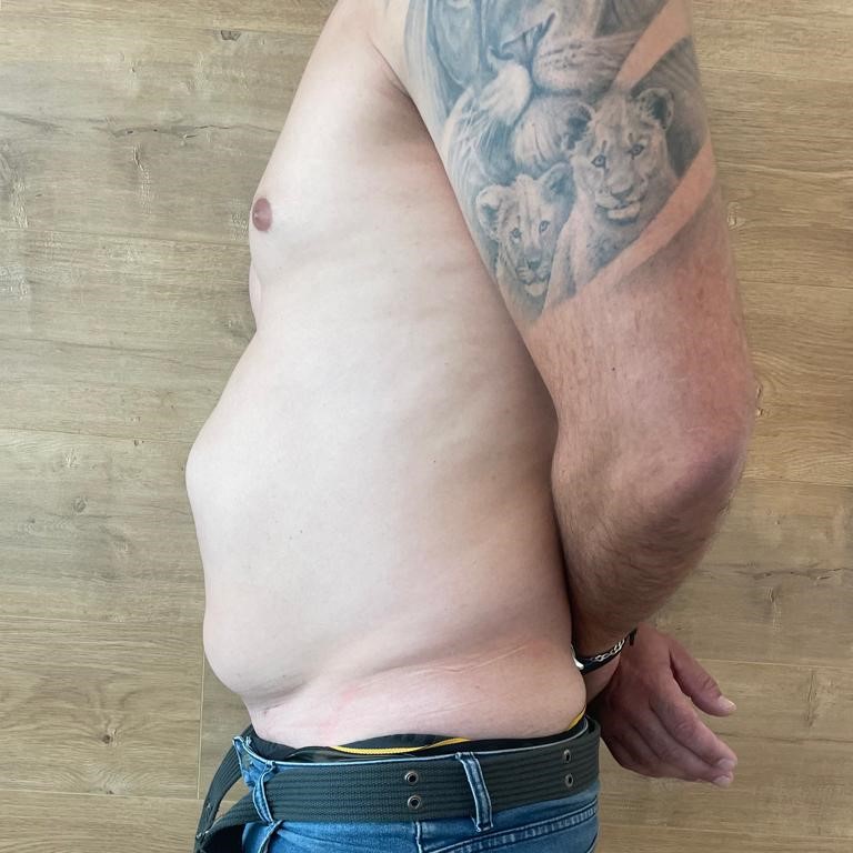 Fotos-Antes-Cirugia-diastasis-convencional (4)