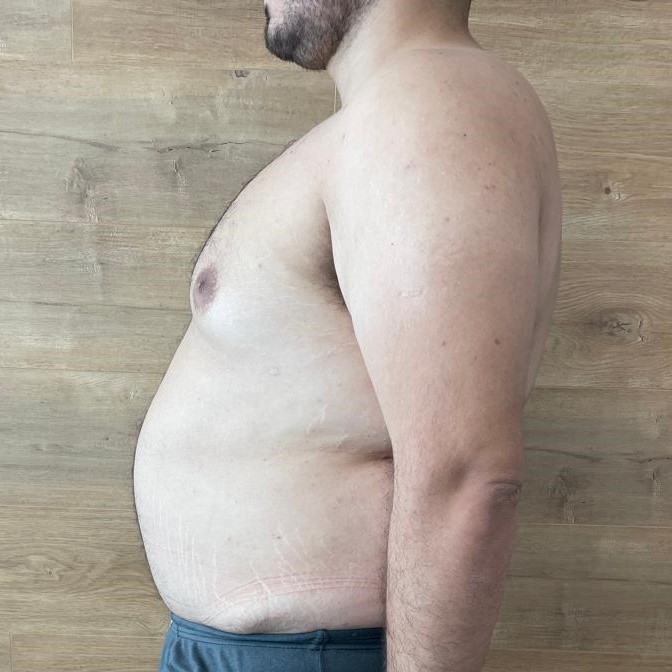 Fotos-Antes-Cirugia-diastasis-convencional (5)