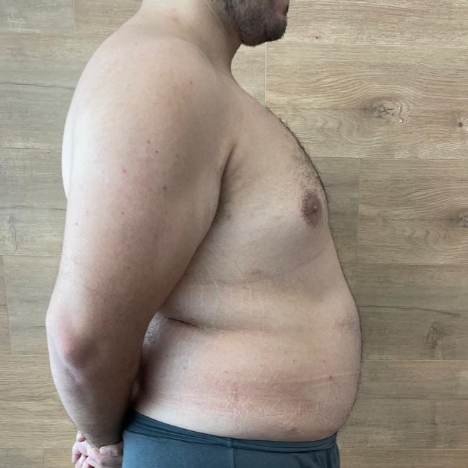 Fotos-Antes-Cirugia-diastasis-convencional (6)