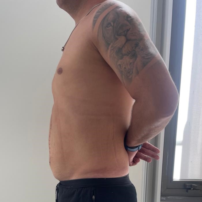 Fotos-Despues-Cirugia-diastasis-convencional (1)