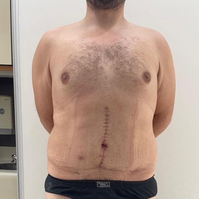 Fotos-Despues-Cirugia-diastasis-convencional (2)