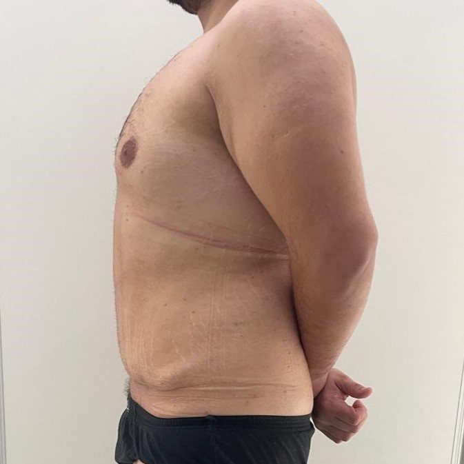 Fotos-Despues-Cirugia-diastasis-convencional (3)