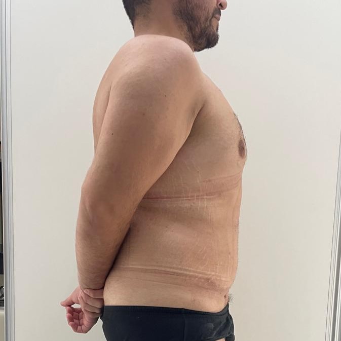 Fotos-Despues-Cirugia-diastasis-convencional (4)