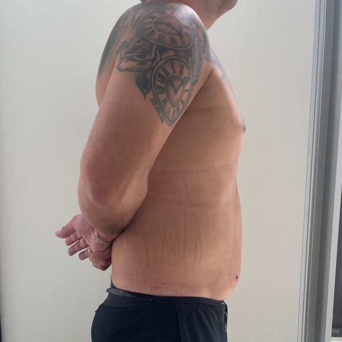 Fotos-Despues-Cirugia-diastasis-convencional (5)