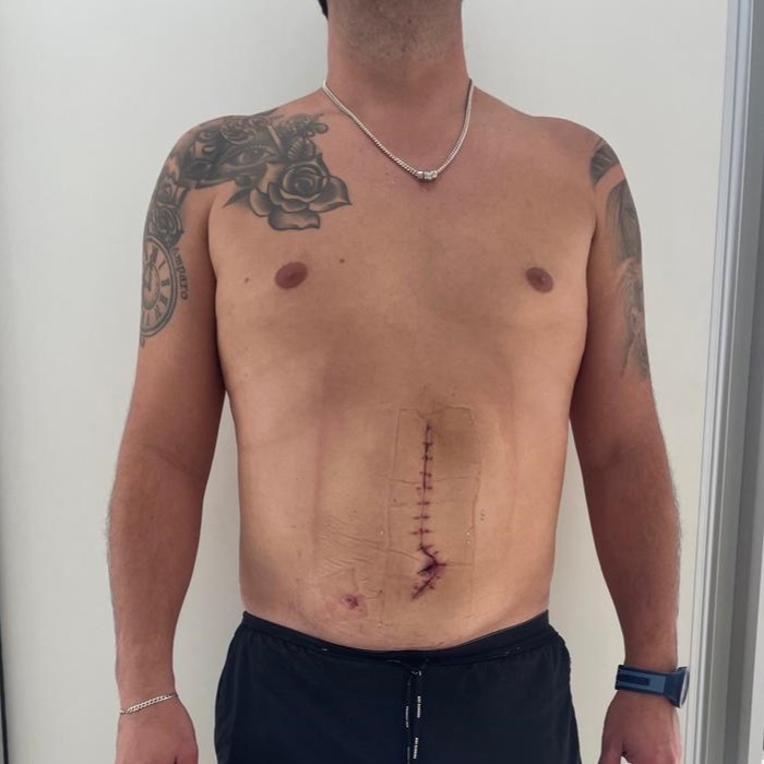 Fotos-Despues-Cirugia-diastasis-convencional (6)